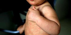 PAHO issues epidemiological alert for measles cases in the Americas